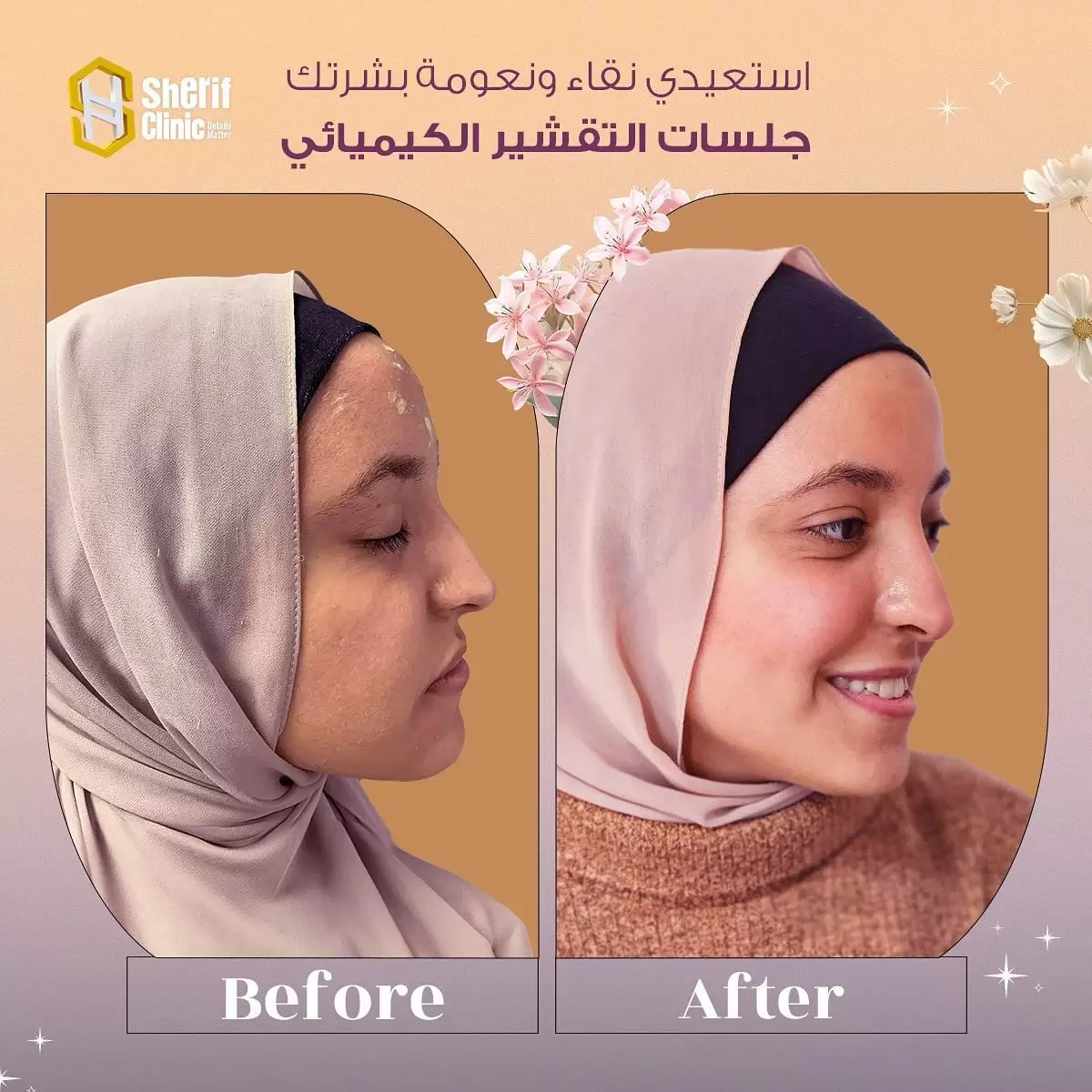 نتائج التقشير الكيميائي للبشرة في شريف كلينك