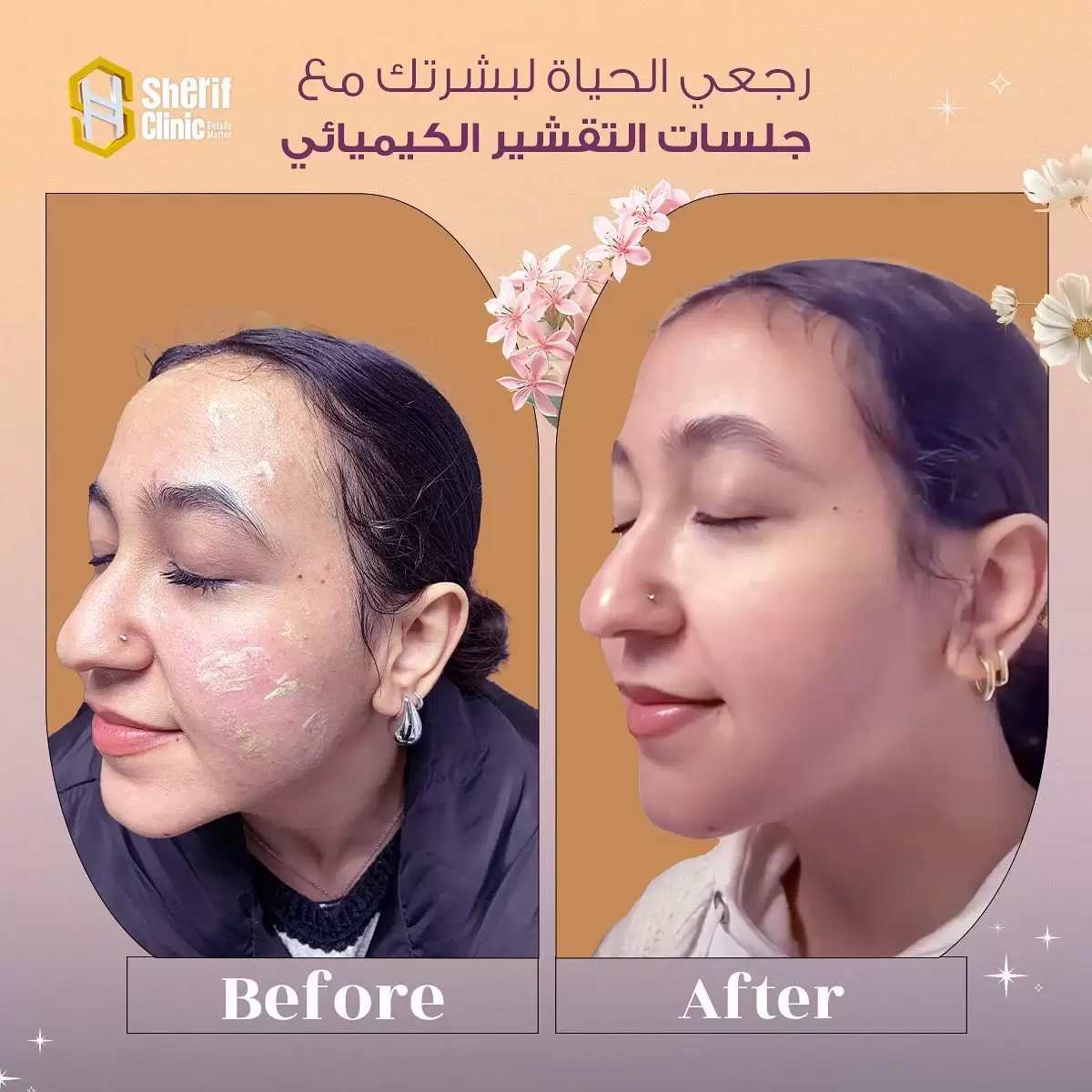 نتائج التقشير الكيميائي للبشرة في شريف كلينك