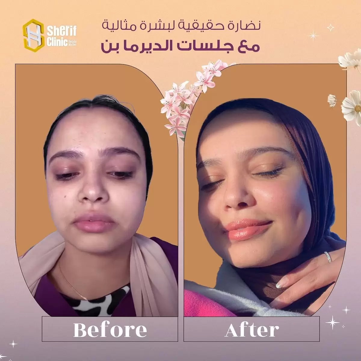 نتائج الديرما بن للبشرة في شريف كلينك
