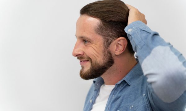 تغطية الرأس بعد زراعة الشعر