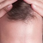 علاج الشعر الخفيف