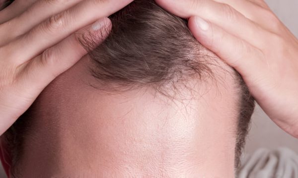 زراعة الشعر الخفيف
