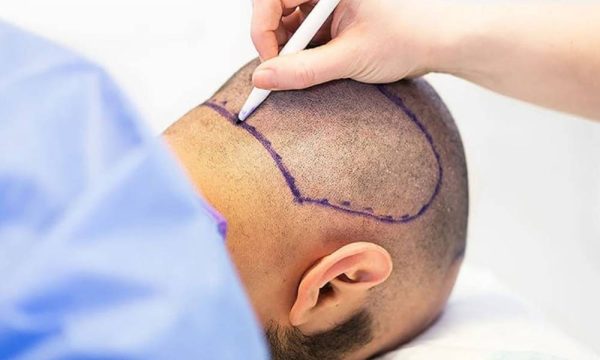 المنطقة المانحة بعد شهرين