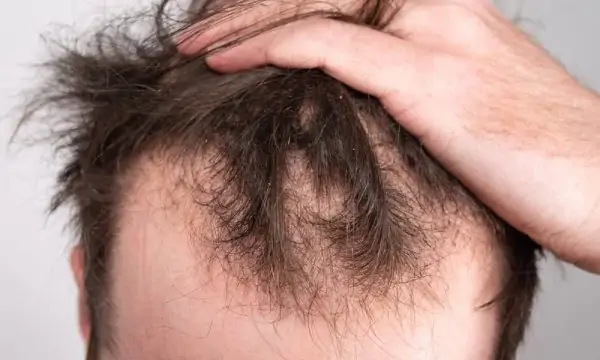 علاج الصلع نهائيا