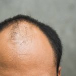 احدث علاج للصلع