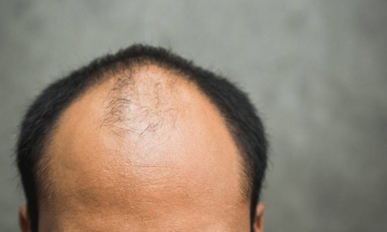 احدث علاج للصلع