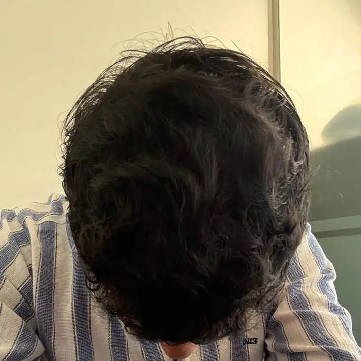 الرئيسية 3 after hair transplant