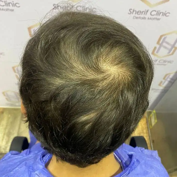 الرئيسية 2 before hair transplant