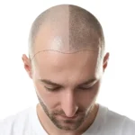 زراعة الشعر