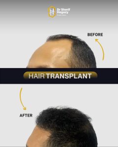 FUE Hair Transplant Before and After