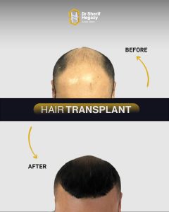 FUE Hair Transplant Before and After