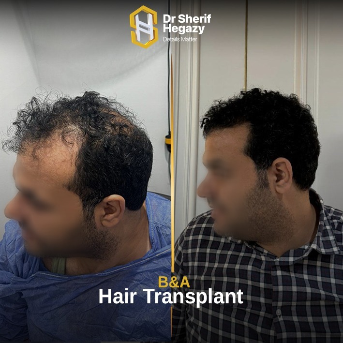 Treating Hereditary-pattern baldness by Hair Transplant Results with Dr. Sherif Hegazy
