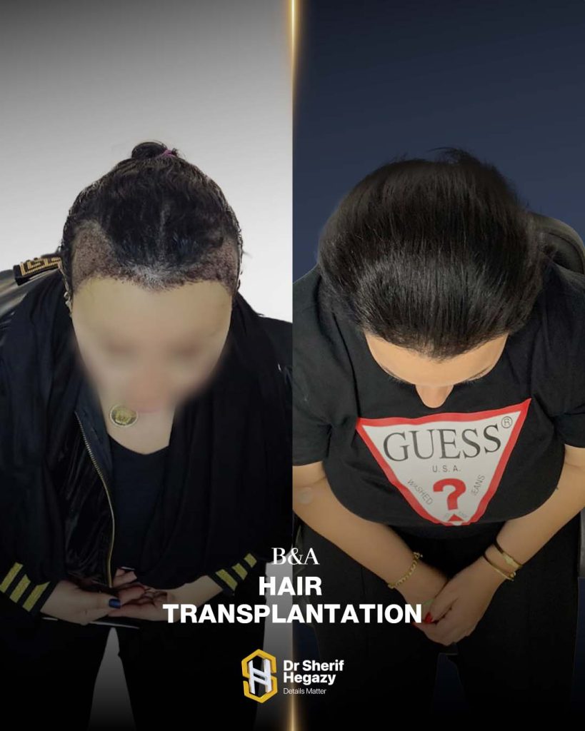 before and after hair transplant