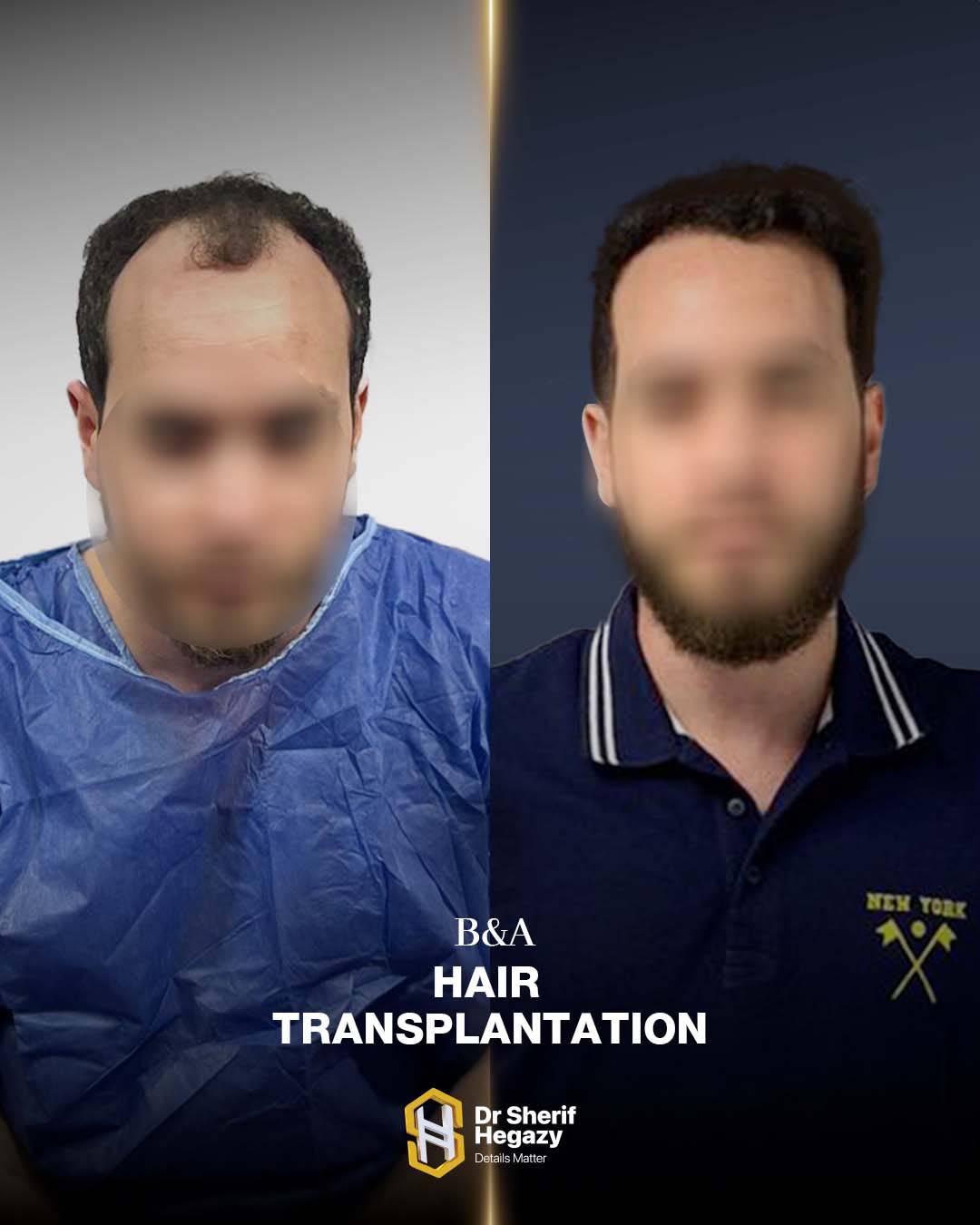 before and after hair transplant
