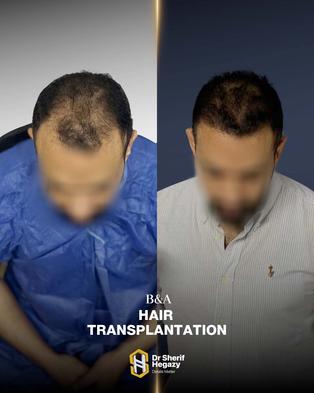 before and after hair transplant