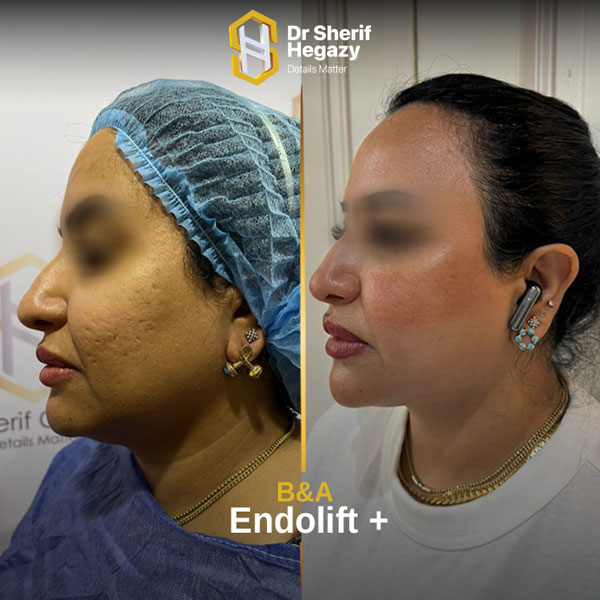 نتائج الشد بالاندولفت بلس