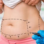 علامات فشل عملية شد البطن