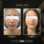 Nano Fat