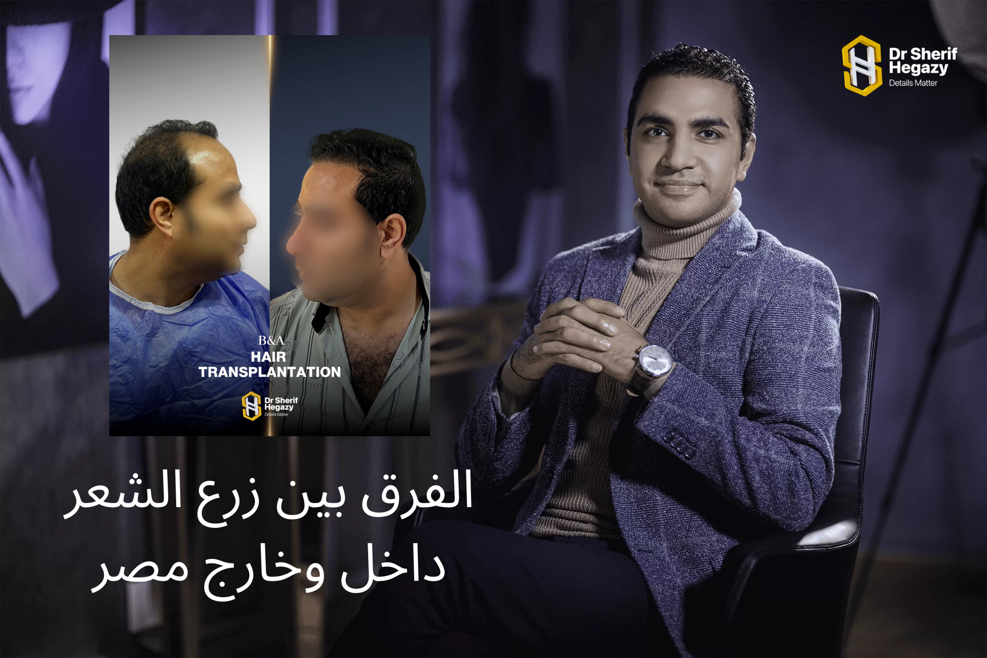 الفرق بين زرع الشعر داخل وخارج مصر