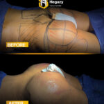 عملية تكبير المؤخرة