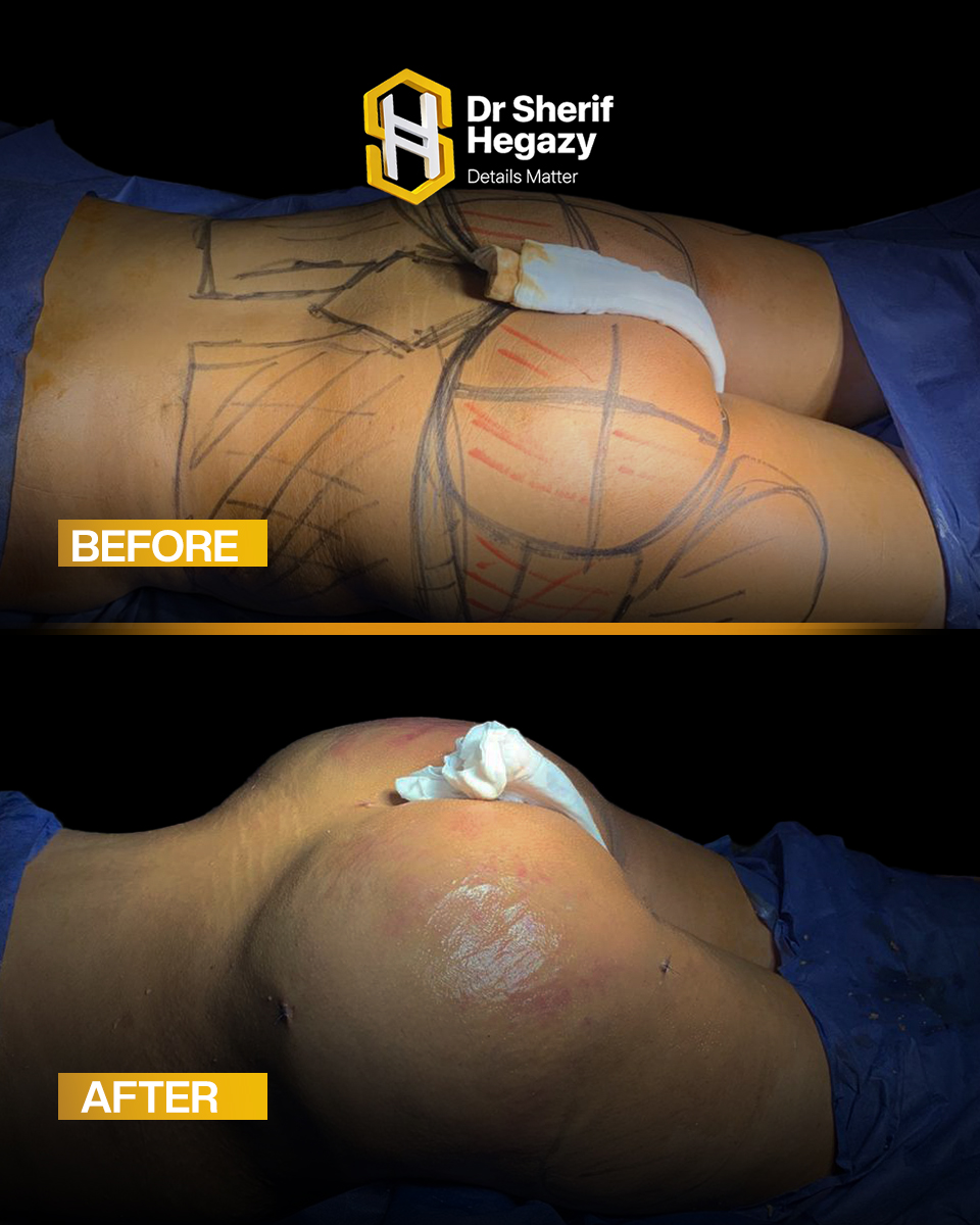 عملية تكبير المؤخرة