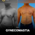 عملية تصغير ثدي الرجال