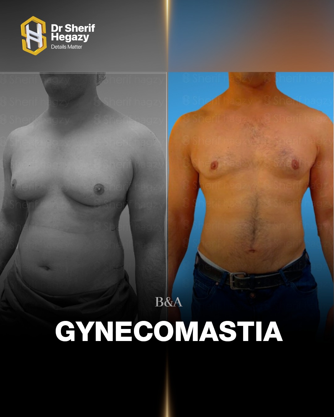 عملية تصغير ثدي الرجال