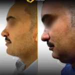 شفط دهون اللغد