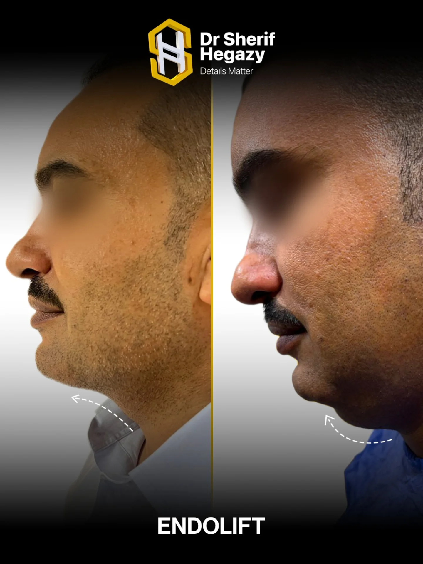 شفط دهون اللغد