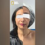 حقن دهون الوجه