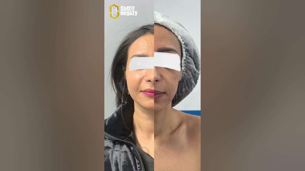 حقن دهون الوجه