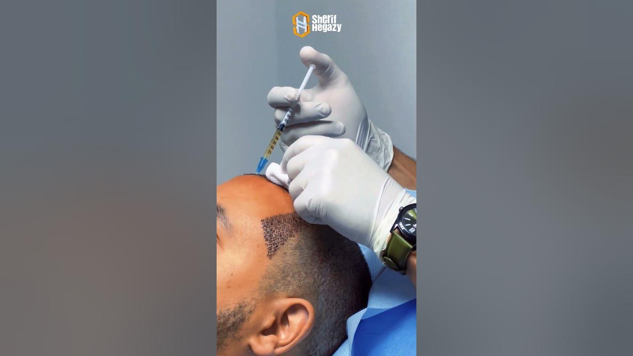 زراعة الشعر