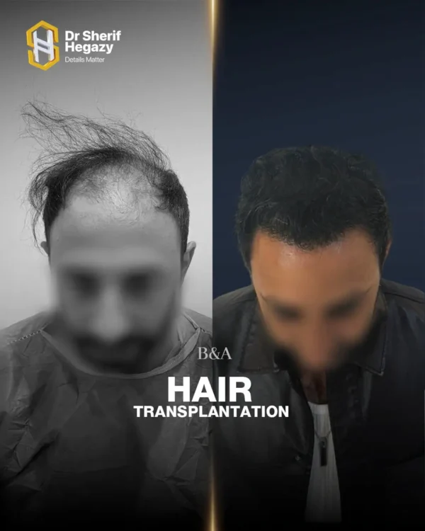 نتيجة زراعة شعر 3