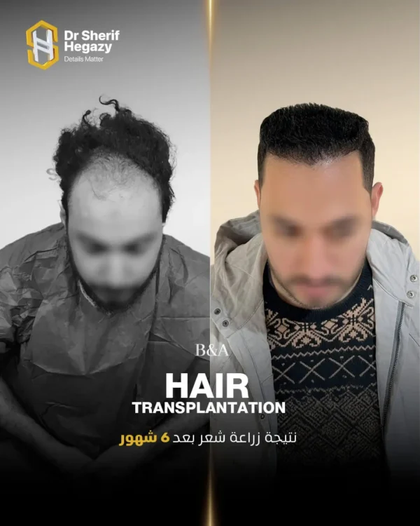 نتيجة زراعة شعر 2