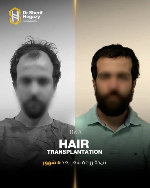 نتيجة زراعة شعر 6