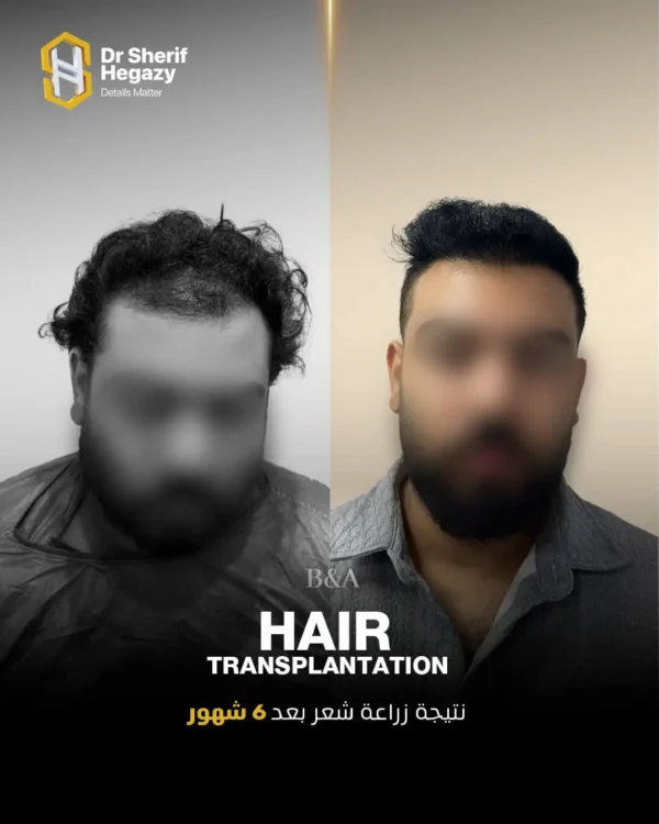 نتيجة زراعة شعر 1