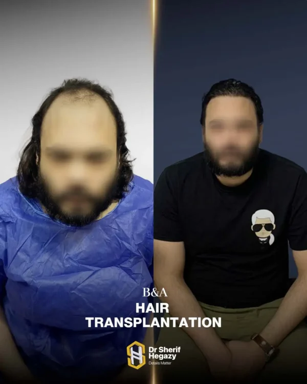 نتيجة زراعة شعر 5