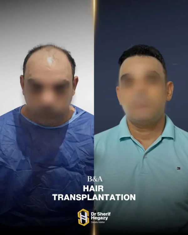 نتيجة زراعة شعر 4