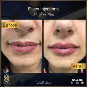 Dermal Fillers: Types, Uses and Risks