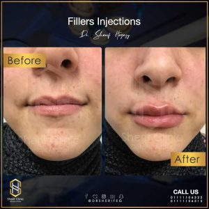 Filler Injection Risks and What to Expect