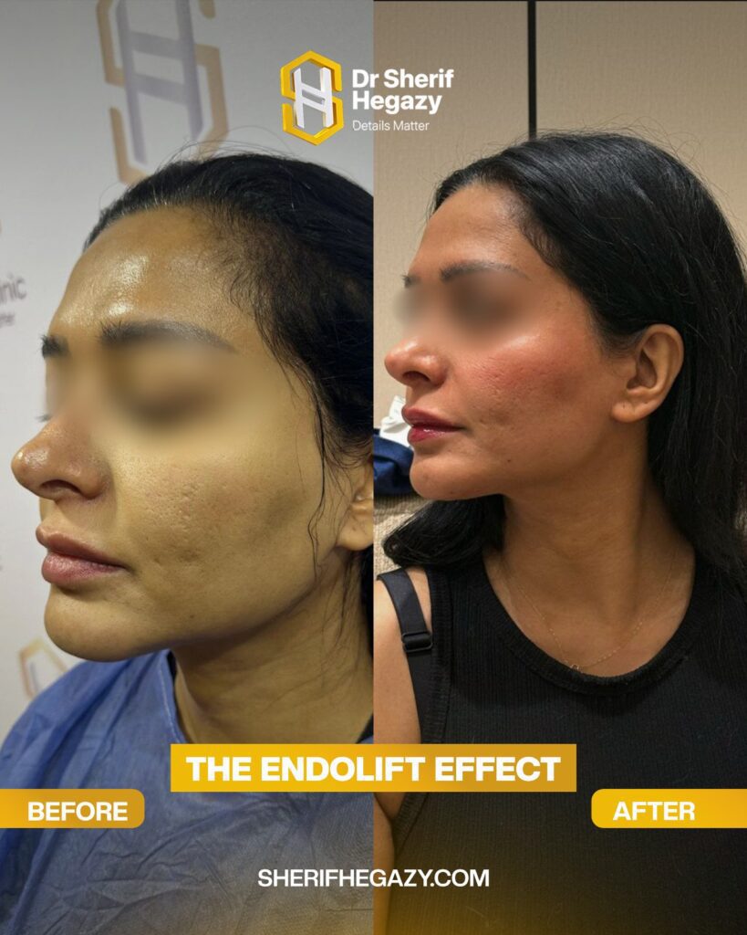 How Endolift Works for Skin Tightening: A Complete Guide