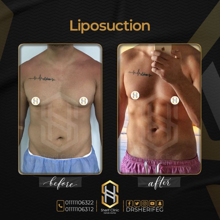 حالات قبل و بعد