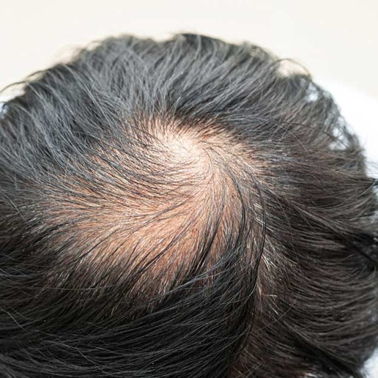 علاج الصلع الوراثي وأفضل الطرق المستخدمة