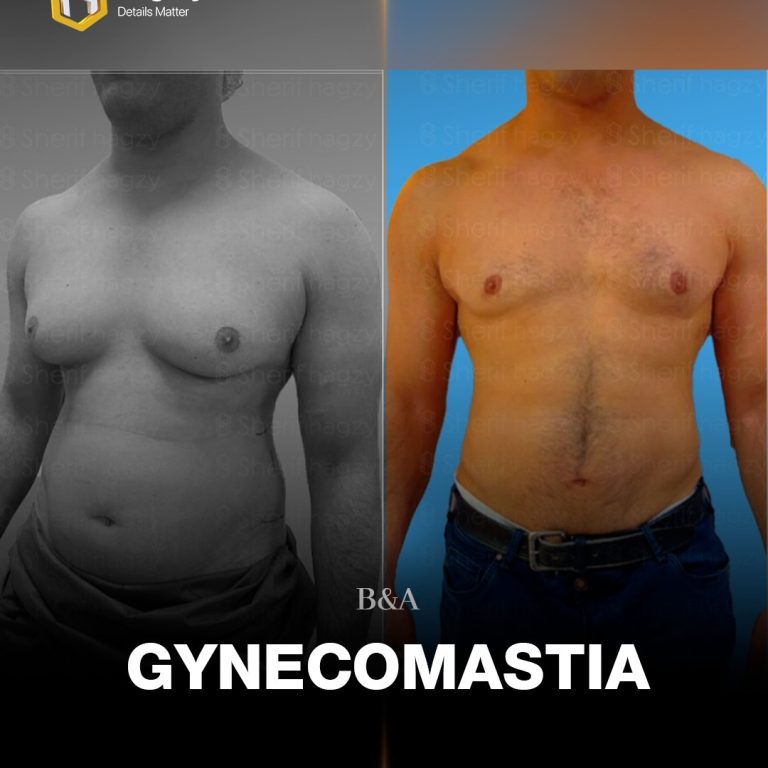 عملية تصغير ثدي الرجال