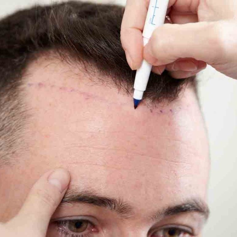 زراعة الشعر