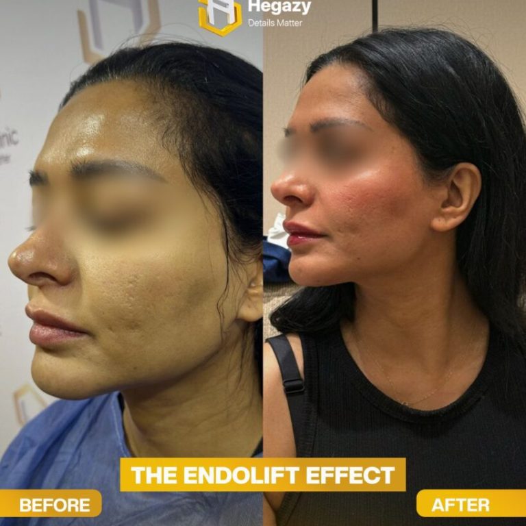 How Endolift Works for Skin Tightening: A Complete Guide