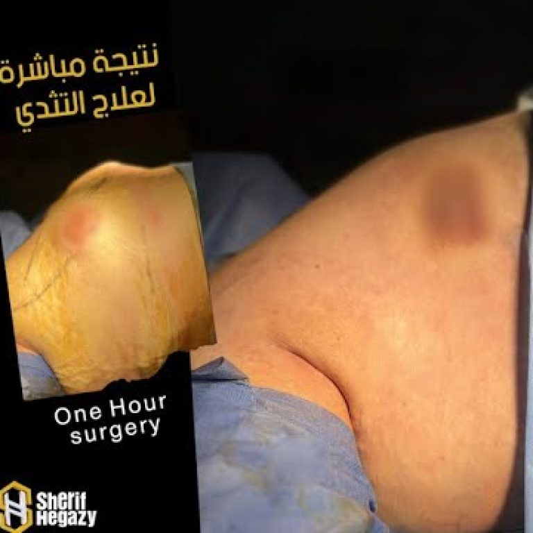 شاهد نتيجة علاج بروز الصدر عند الرجال (التثدي ) ونصائح من داخل غرفة العمليات