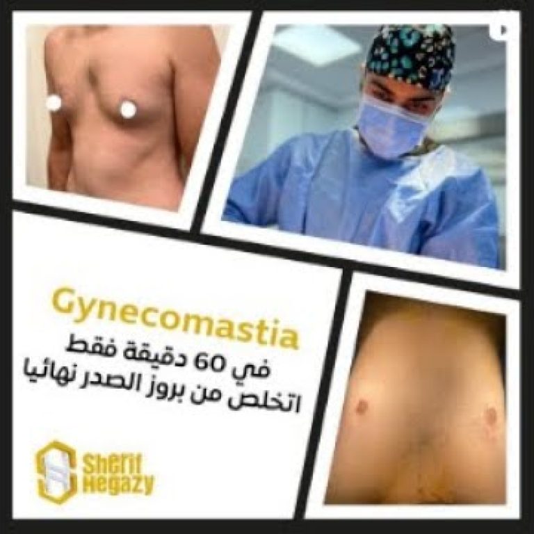 تخلص من بروز الصدر نهائياٌ في 60 دقيقة فقط