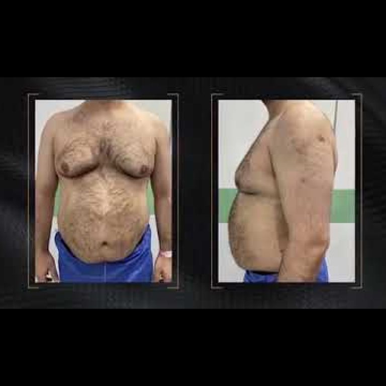 نحت البطن والتثدي