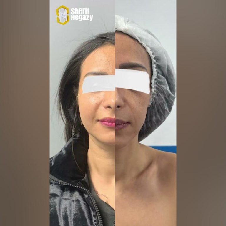 حقن دهون الوجه